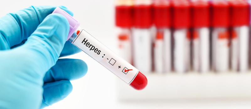 At Home Herpes Testing | Pediatrix